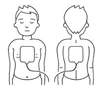 小児の場合は小児用パッドを使用し、胸部と背中に電飾パットを貼り付けているイラスト